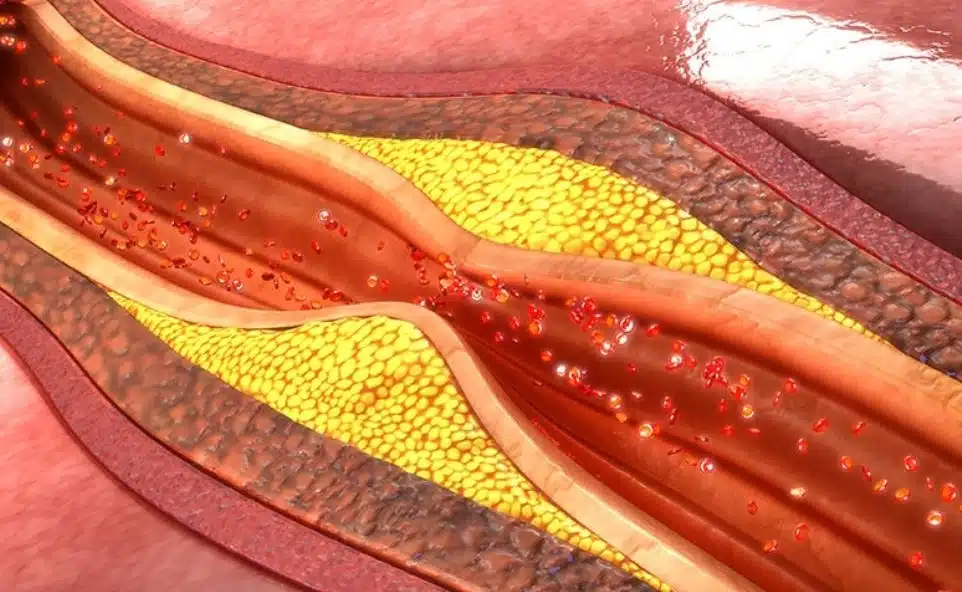 berberine reverses atherosclerosis