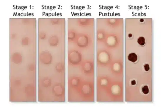 stages of MPOX